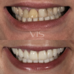 Sorriso VIS com individualidade e naturalidade.
